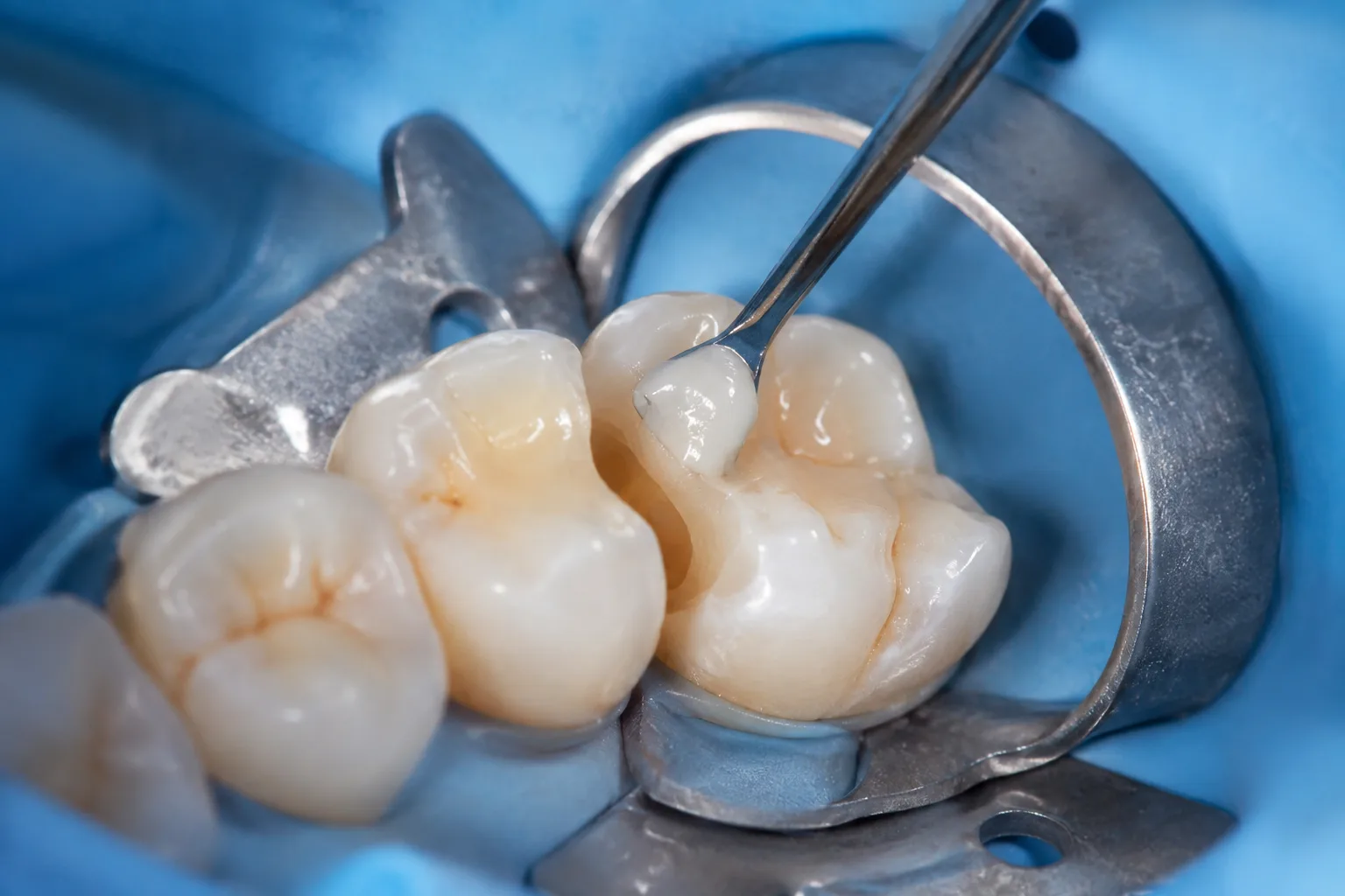 Restoratif Diş Tedavisi Neden Yapılır? Nasıl Sonuç Verir?